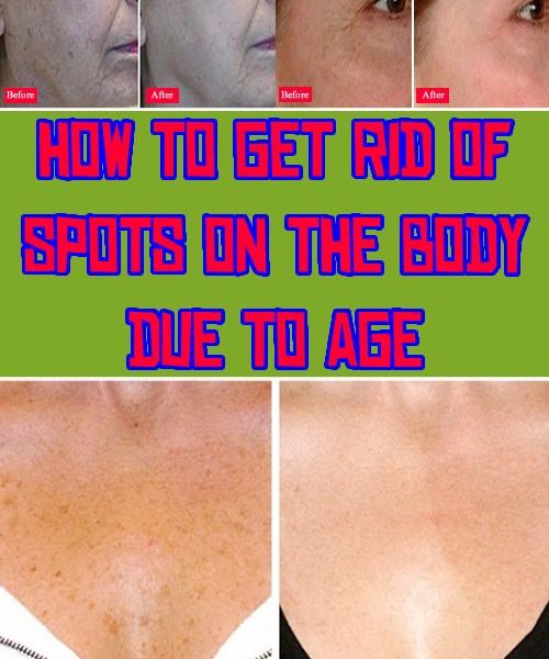 how-to-get-rid-of-spots-on-the-body-due-to-age-my-wordpress-website