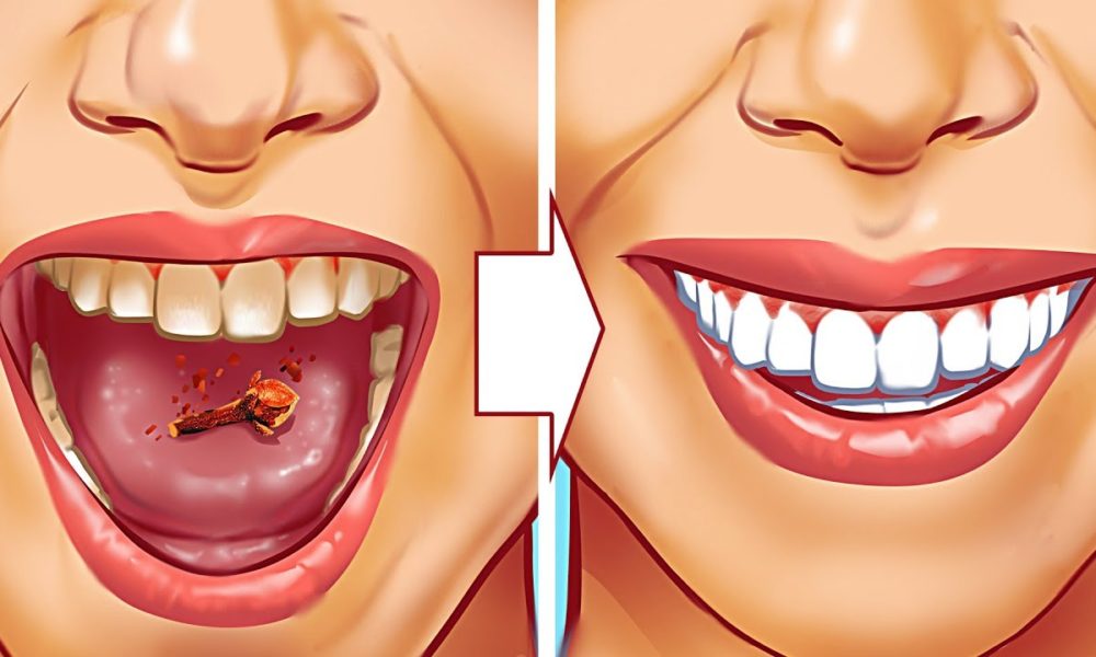 Naturally Whiten Teeth 10 Ways To Remove Tartar Stains From Your Teeth