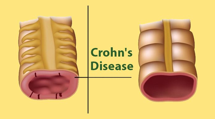 Every Woman Need To Know The Warning Signs Of Crohns Disease My Wordpress Website 